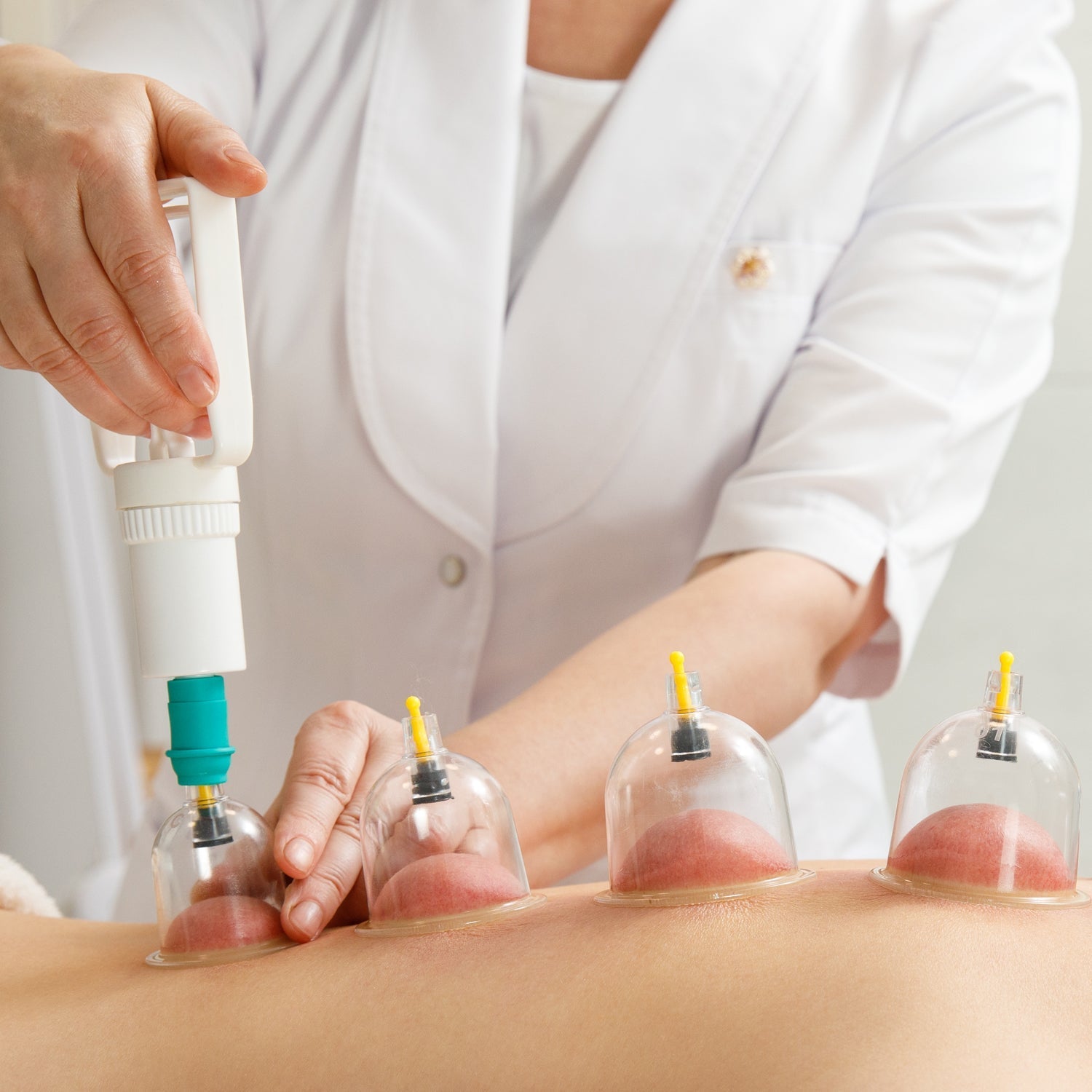 Six-piece cupping set for vacuum therapy and muscle relaxation. Six-piece cupping set for vacuum therapy and muscle relaxation.